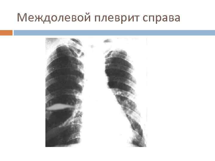 Междолевой плеврит справа 