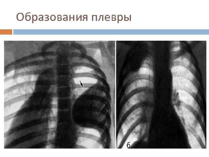 Образования плевры 