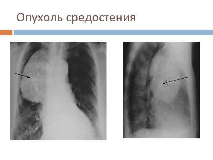 Опухоль средостения 