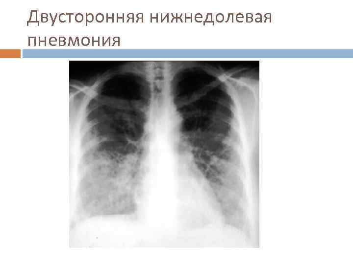 Двусторонняя нижнедолевая пневмония 