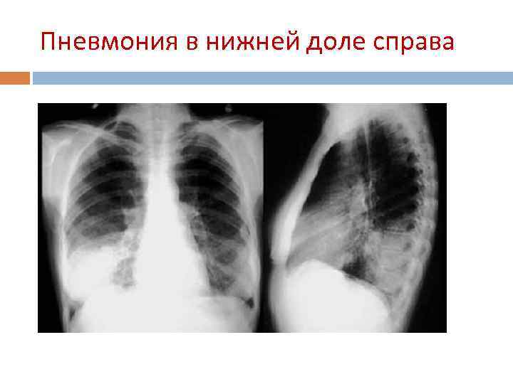 Пневмония в нижней доле справа 