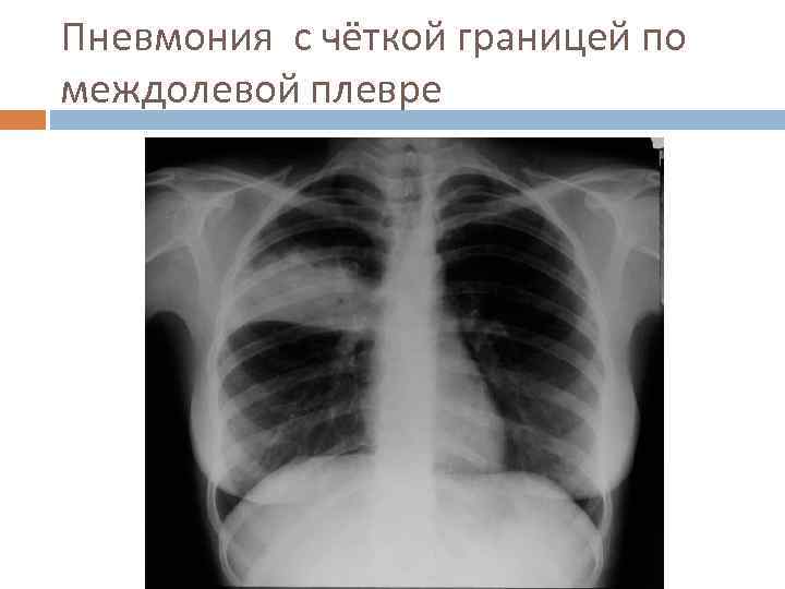 Пневмония с чёткой границей по междолевой плевре 