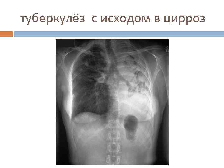 туберкулёз с исходом в цирроз 