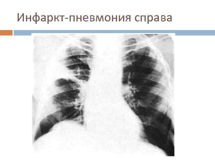 Инфаркт-пневмония справа 