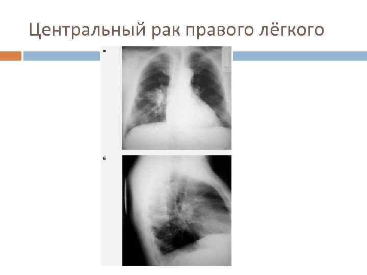 Центральный рак правого лёгкого 