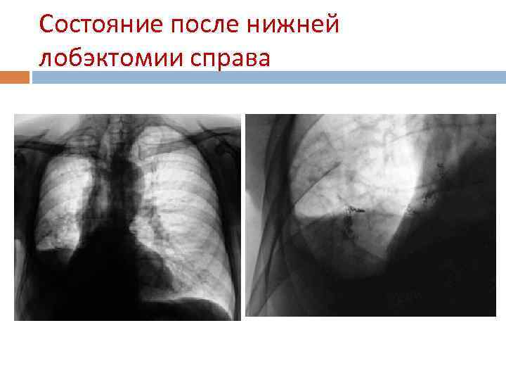 Состояние после нижней лобэктомии справа 