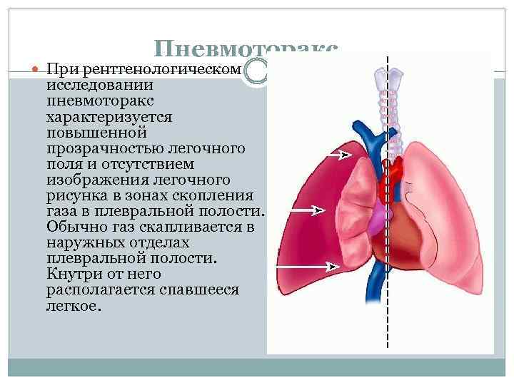 Пневмоторакс. При рентгенологическом исследовании пневмоторакс характеризуется повышенной прозрачностью легочного поля и отсутствием изображения легочного