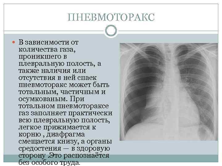 ПНЕВМОТОРАКС В зависимости от количества газа, проникшего в плевральную полость, а также наличия или