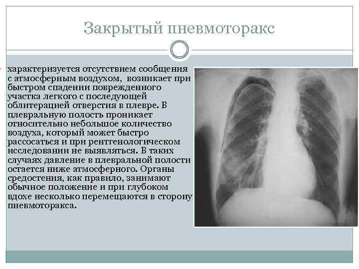 Закрытый пневмоторакс характеризуется отсутствием сообщения с атмосферным воздухом, возникает при быстром спадении поврежденного участка