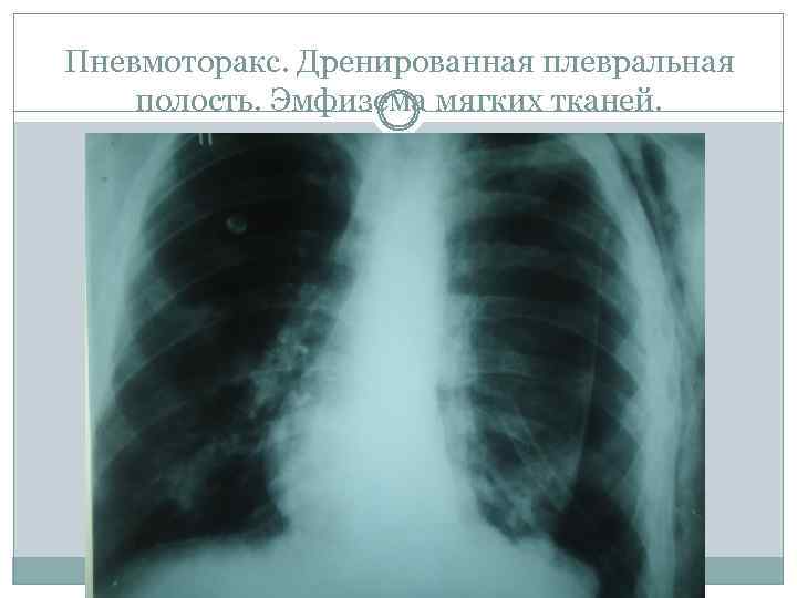 Пневмоторакс. Дренированная плевральная полость. Эмфизема мягких тканей. 