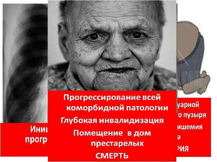 Саркопения – неизбежный атрибут старения, резко снижающий КАЧЕСТВО ЖИЗНИ стареющего человека, связанный с дефицитом