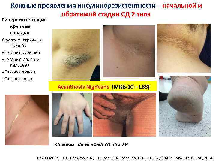 Кожные проявления инсулинорезистентности – начальной и обратимой стадии СД 2 типа Гиперпигментация крупных складок
