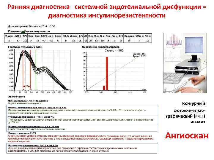 Ранняя диагностика системной эндотелиальной дисфункции = диагностика инсулинорезистентности Контурный фотоплетизмографический (ФПГ) анализ Ангиоскан 