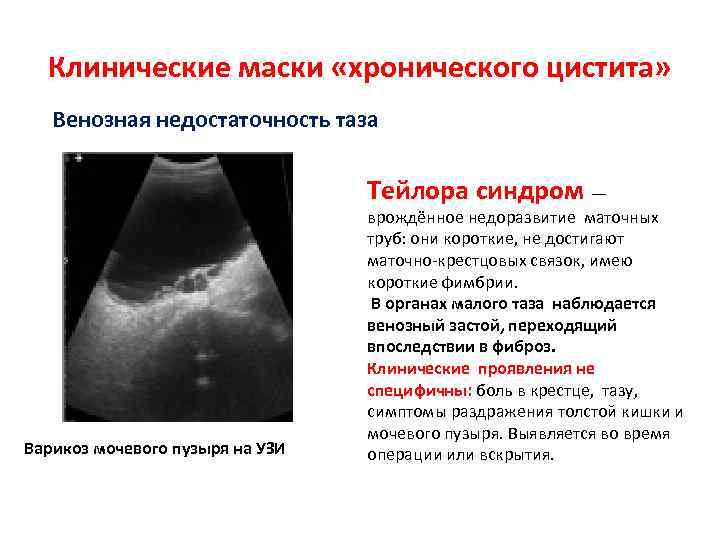 Клинические маски «хронического цистита» Венозная недостаточность таза Тейлора синдром — Варикоз мочевого пузыря на