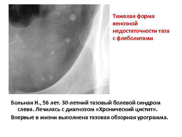 Тяжелая форма венозной недостаточности таза с флеболитами Больная Н. , 56 лет. 30 -летний