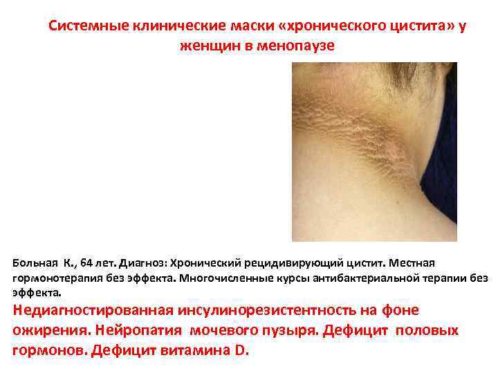 Системные клинические маски «хронического цистита» у женщин в менопаузе Больная К. , 64 лет.