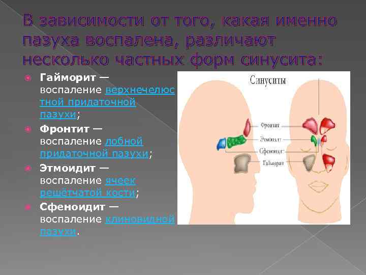 В зависимости от того, какая именно пазуха воспалена, различают несколько частных форм синусита: Гайморит