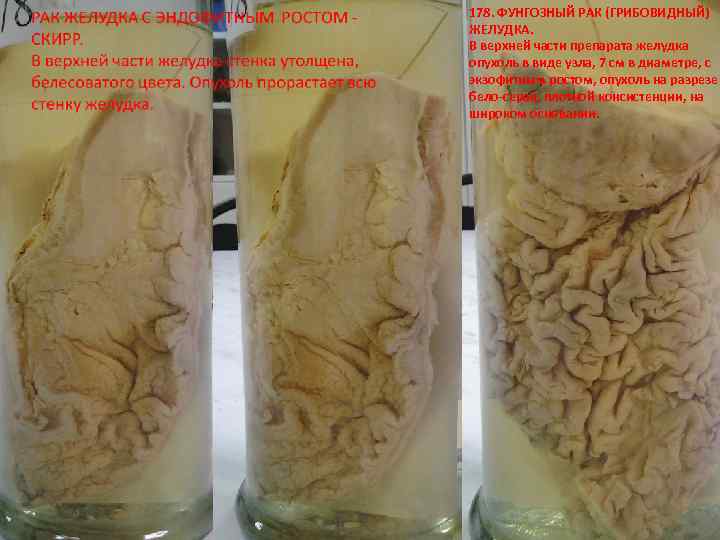 178. ФУНГОЗНЫЙ РАК (ГРИБОВИДНЫЙ) ЖЕЛУДКА. В верхней части препарата желудка опухоль в виде узла,