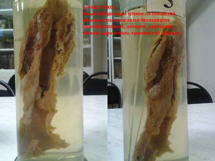 5. РАК ТРАХЕИ. Выше бифуркации трахеи на слизистой оболочке располагается белесоватое новообразование, которое, охватывая