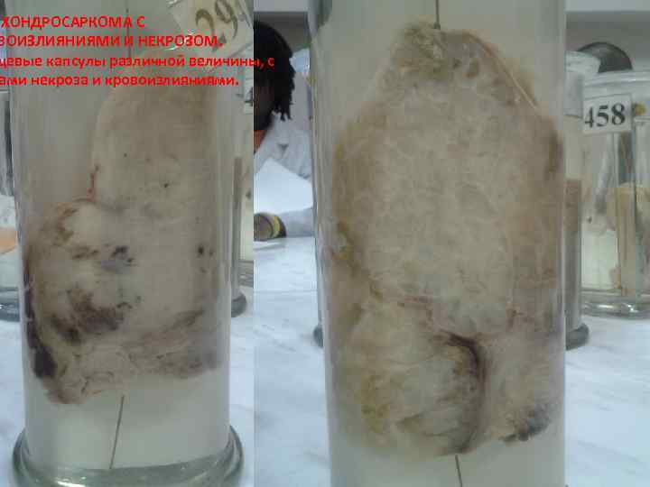 ХОНДРОСАРКОМА С ВОИЗЛИЯНИЯМИ И НЕКРОЗОМ. щевые капсулы различной величины, с ами некроза и кровоизлияниями.