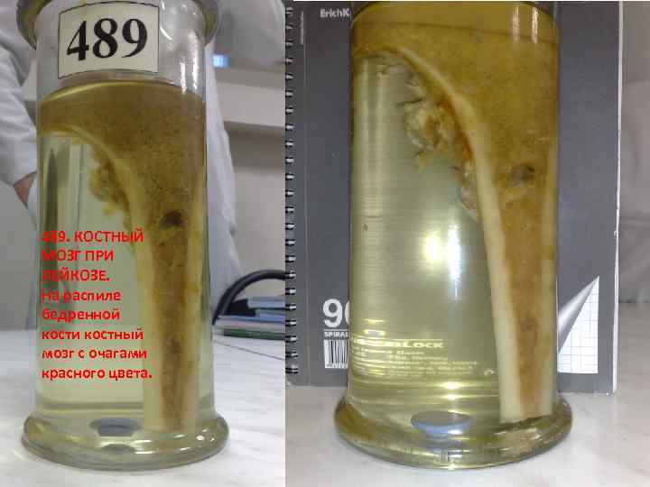 489. КОСТНЫЙ МОЗГ ПРИ ЛЕЙКОЗЕ. На распиле бедренной кости костный мозг с очагами красного