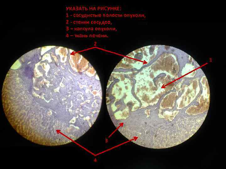 УКАЗАТЬ НА РИСУНКЕ: 1 - сосудистые полости опухоли, 2 - стенки сосудов, 3 –