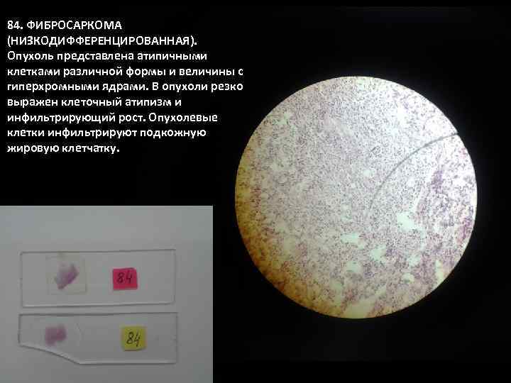 84. ФИБРОСАРКОМА (НИЗКОДИФФЕРЕНЦИРОВАННАЯ). Опухоль представлена атипичными клетками различной формы и величины с гиперхромными ядрами.