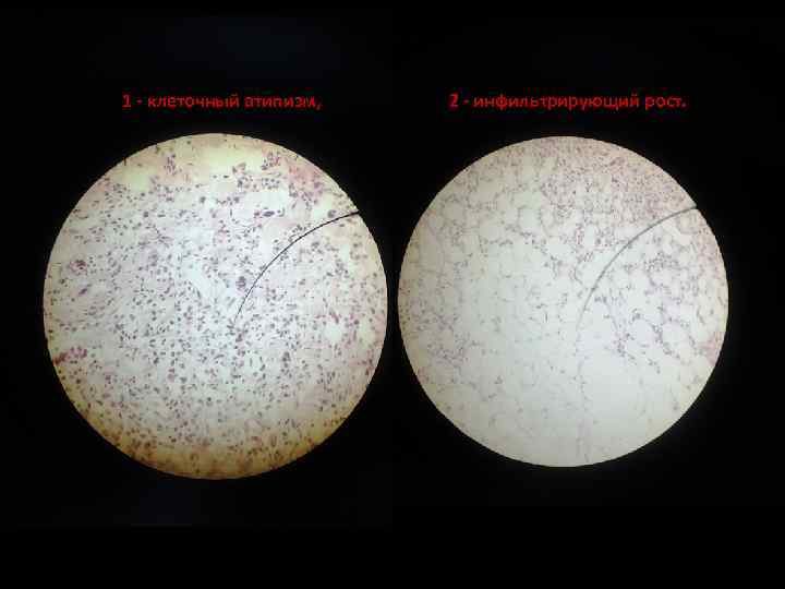 1 - клеточный атипизм, 2 - инфильтрирующий рост. 