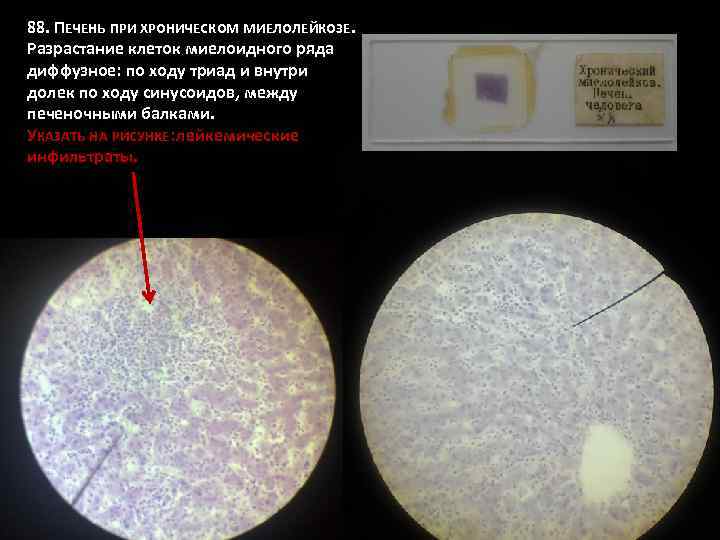 Печень при хроническом миелолейкозе микропрепарат рисунок