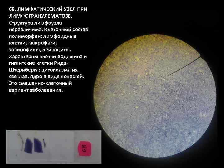 68. ЛИМФАТИЧЕСКИЙ УЗЕЛ ПРИ ЛИМФОГРАНУЛЕМАТОЗЕ. Структура лимфоузла неразличима. Клеточный состав полиморфен: лимфоидные клетки, макрофаги,