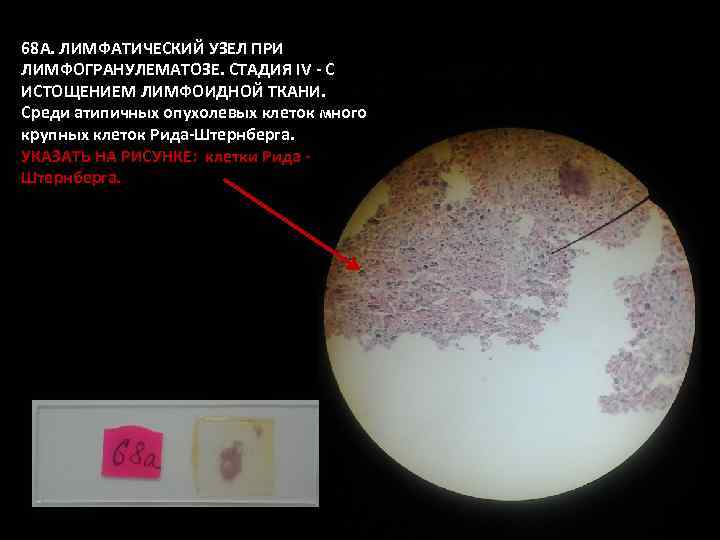 68 А. ЛИМФАТИЧЕСКИЙ УЗЕЛ ПРИ ЛИМФОГРАНУЛЕМАТОЗЕ. СТАДИЯ IV - С ИСТОЩЕНИЕМ ЛИМФОИДНОЙ ТКАНИ. Среди