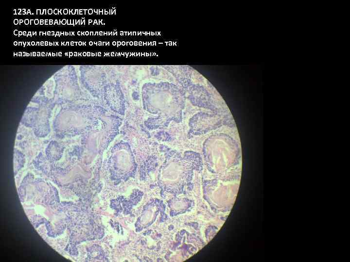 123 А. ПЛОСКОКЛЕТОЧНЫЙ ОРОГОВЕВАЮЩИЙ РАК. Среди гнездных скоплений атипичных опухолевых клеток очаги ороговения –