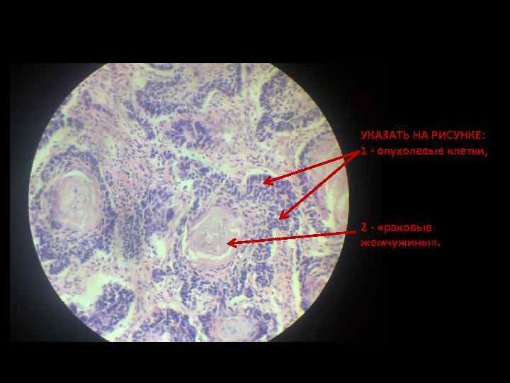 УКАЗАТЬ НА РИСУНКЕ: 1 - опухолевые клетки, 2 - «раковые жемчужины» . 