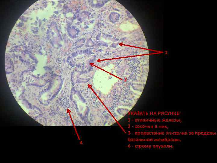 1 2 4 УКАЗАТЬ НА РИСУНКЕ: 1 - атипичные железы, 2 - сосочки в