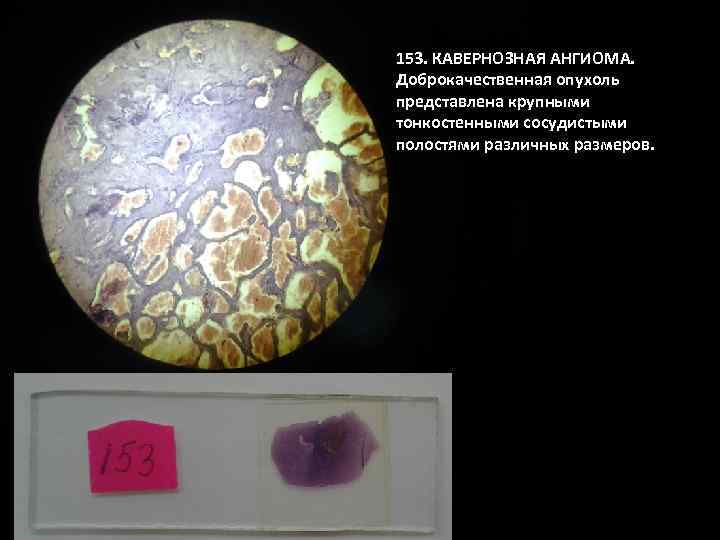 153. КАВЕРНОЗНАЯ АНГИОМА. Доброкачественная опухоль представлена крупными тонкостенными сосудистыми полостями различных размеров. 