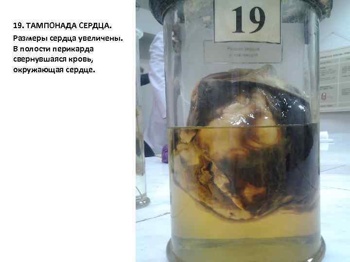19. ТАМПОНАДА СЕРДЦА. Размеры сердца увеличены. В полости перикарда свернувшаяся кровь, окружающая сердце. 