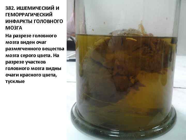 382. ИШЕМИЧЕСКИЙ И ГЕМОРРАГИЧЕСКИЙ ИНФАРКТЫ ГОЛОВНОГО МОЗГА На разрезе головного мозга виден очаг размягченного