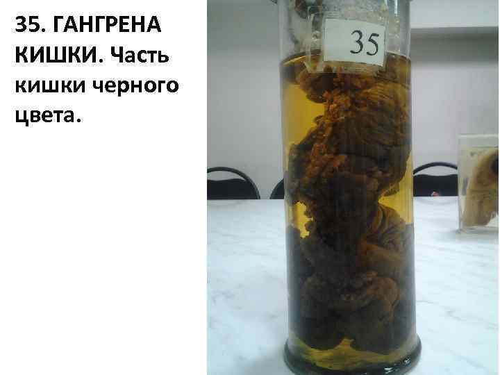 35. ГАНГРЕНА КИШКИ. Часть кишки черного цвета. 