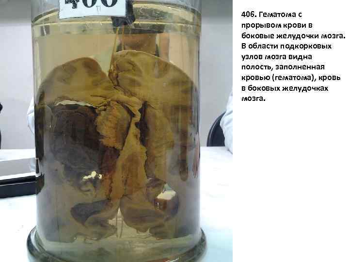 406 406. Гематома с прорывом крови в боковые желудочки мозга. В области подкорковых узлов