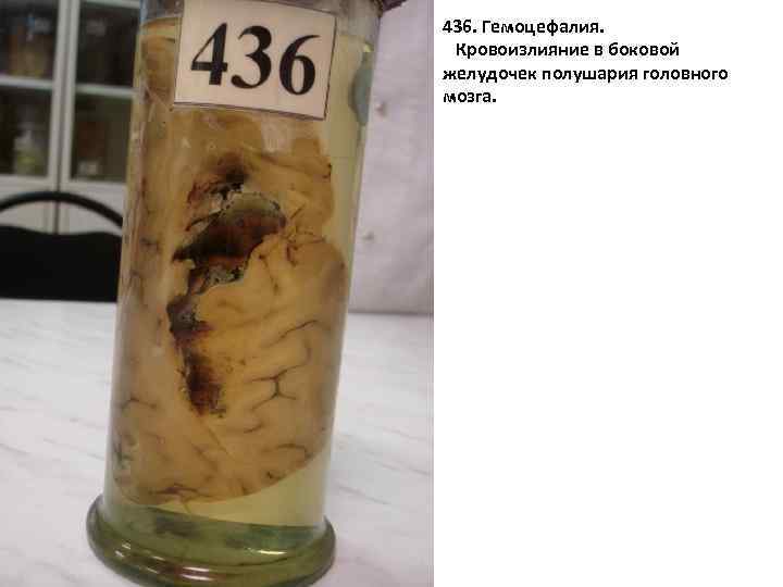 436. Гемоцефалия. Кровоизлияние в боковой желудочек полушария головного мозга. 436 