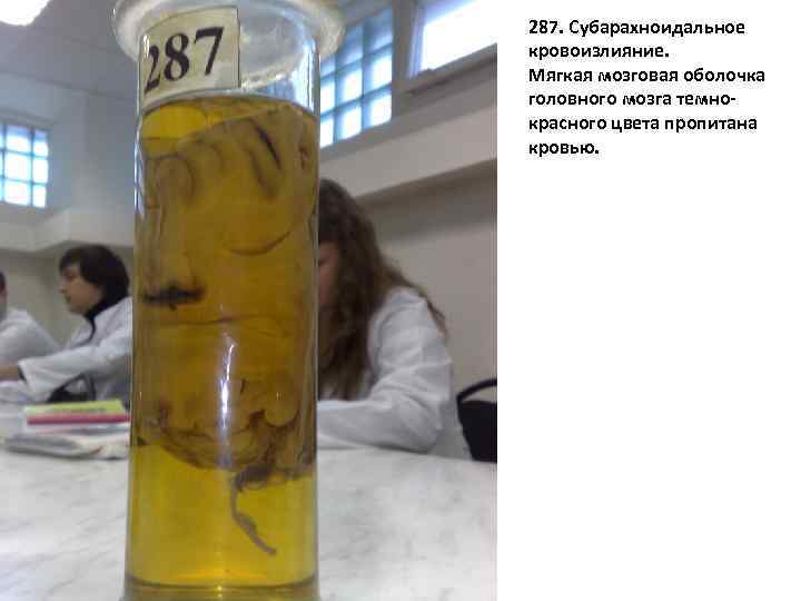 287 287. Субарахноидальное кровоизлияние. Мягкая мозговая оболочка головного мозга темнокрасного цвета пропитана кровью. 