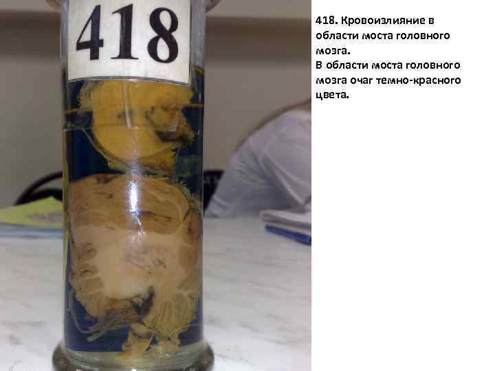 418 418. Кровоизлияние в области моста головного мозга. В области моста головного мозга очаг