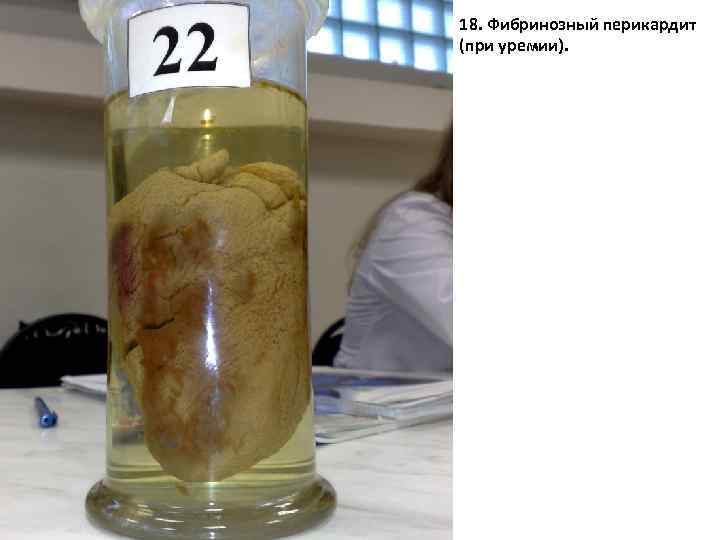 18 18. Фибринозный перикардит (при уремии). 