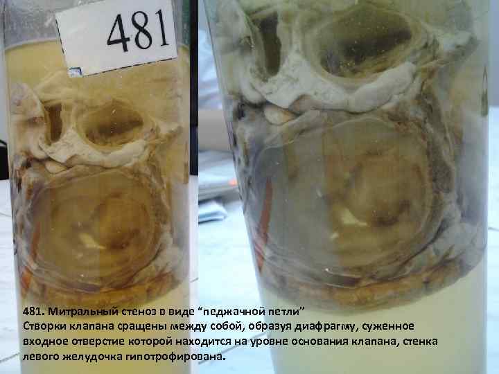 481. Митральный стеноз в виде “педжачной петли” Створки клапана сращены между собой, образуя диафрагму,