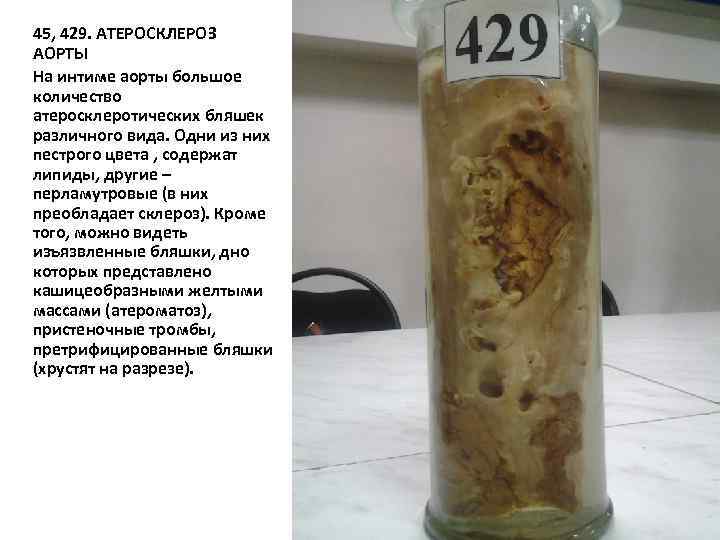 45, 429. АТЕРОСКЛЕРОЗ АОРТЫ На интиме аорты большое количество атеросклеротических бляшек различного вида. Одни
