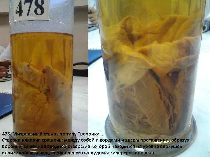 478. Митральный стеноз по типу 
