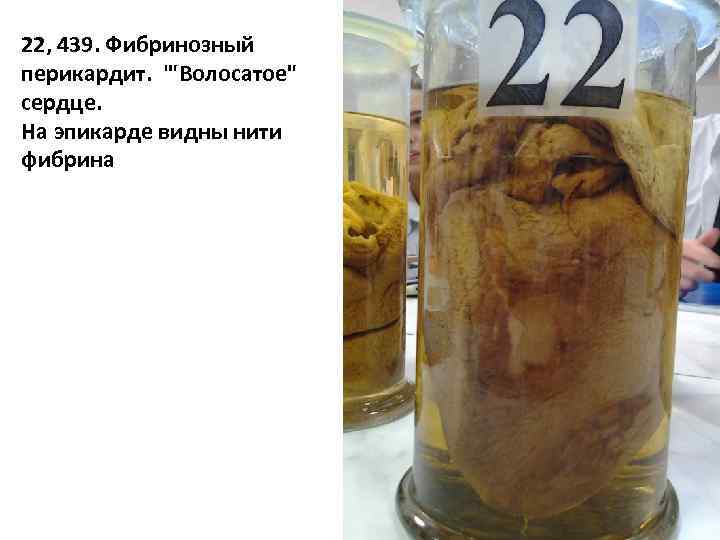 22, 439. Фибринозный перикардит. '