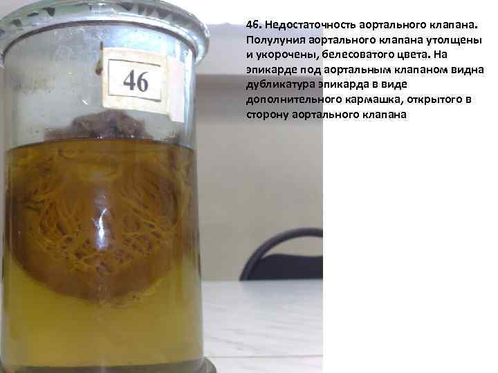 46. Недостаточность аортального клапана. Полулуния аортального клапана утолщены и укорочены, белесоватого цвета. На эпикарде