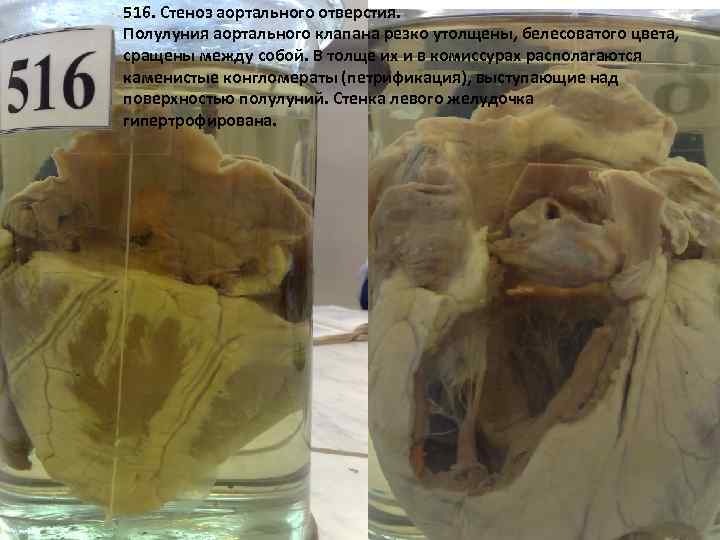 516. Стеноз аортального отверстия. Полулуния аортального клапана резко утолщены, белесоватого цвета, сращены между собой.