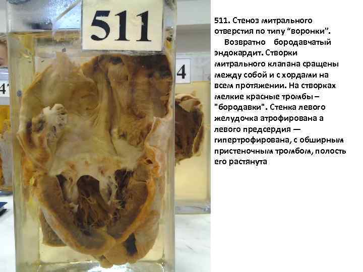 511 511. Стеноз митрального отверстия по типу “воронки”. Возвратно бородавчатый эндокардит. Створки митрального клапана